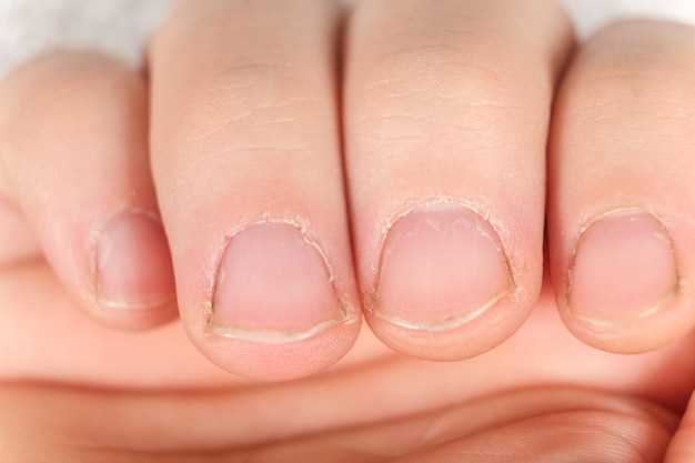 Симптомы и признаки грибка на ногтях рук