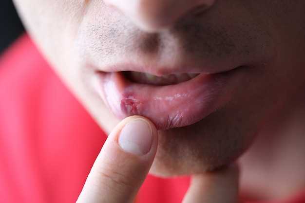 Что такое стоматит на губе?