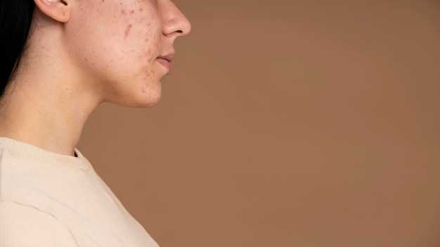 Подкожный клещ на лице: особенности и признаки